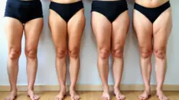 Descubra Lipedema: O Que Está Por Trás Dessa Condição